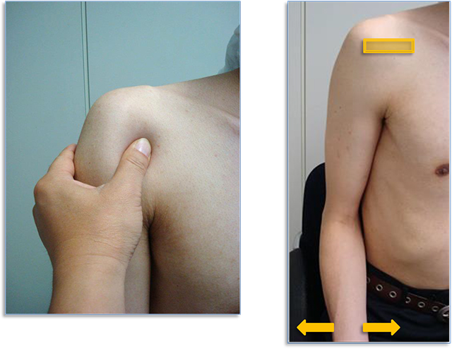 図　肩関節の観察法　烏口上腕靭帯の観察の基本肢位