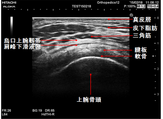 図　腱板位置での烏口上腕靭帯の超音波画像