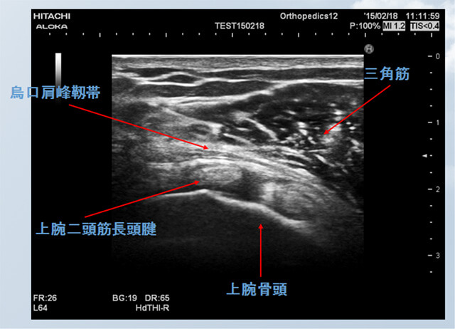 図　超音波で見ると烏口肩峰靭帯と腱板、上腕骨頭
